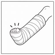 骨折したことある？イメージ（※生成AIで作成）